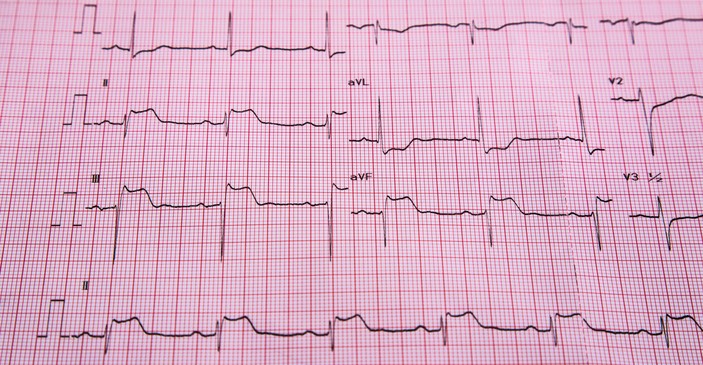 EKG - STEMI - znaki dviga ST in infarkta srčne mišice