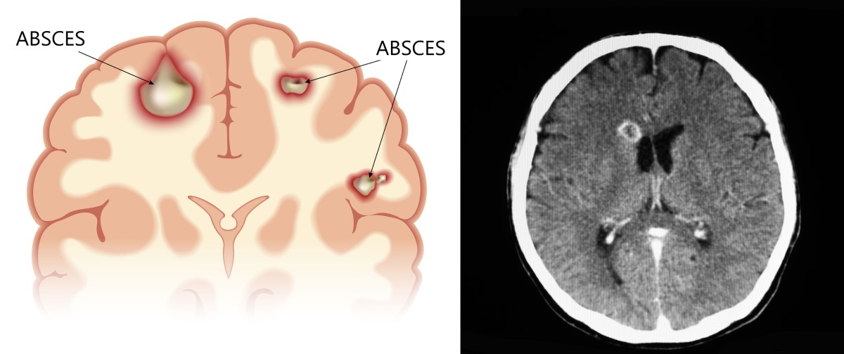 Anatomski pogledi in CT-posnetki možganskega abscesa