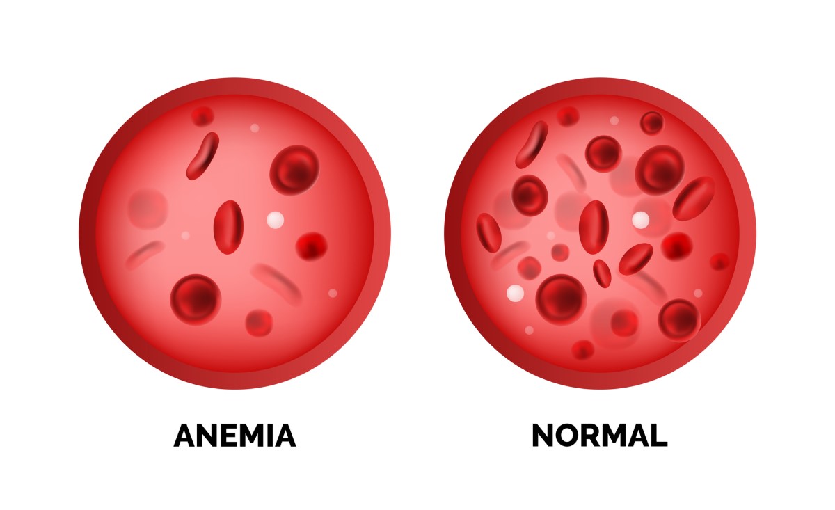 Anemija in normalna raven rdečih krvnih celic