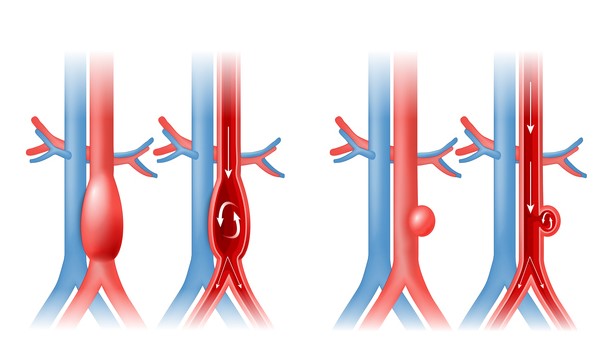 Anevrizma aorte in pretok krvi