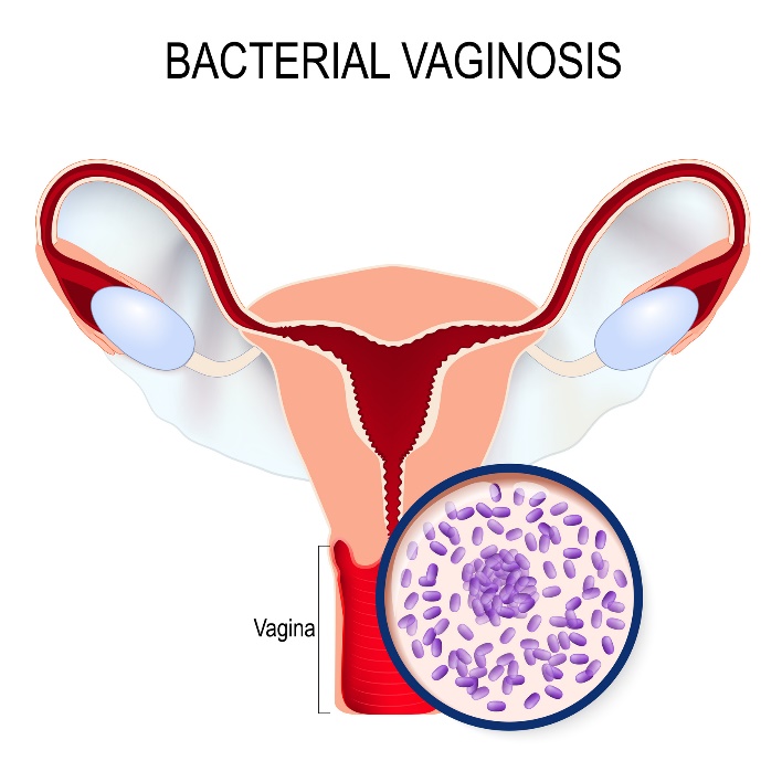 Bakterijska vaginoza in prekomerna rast Gardnerella vaginalis