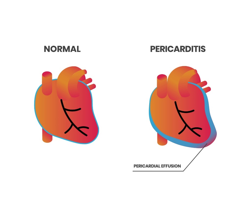 Fiziologija srca in perikarditis (perikardialni izliv)