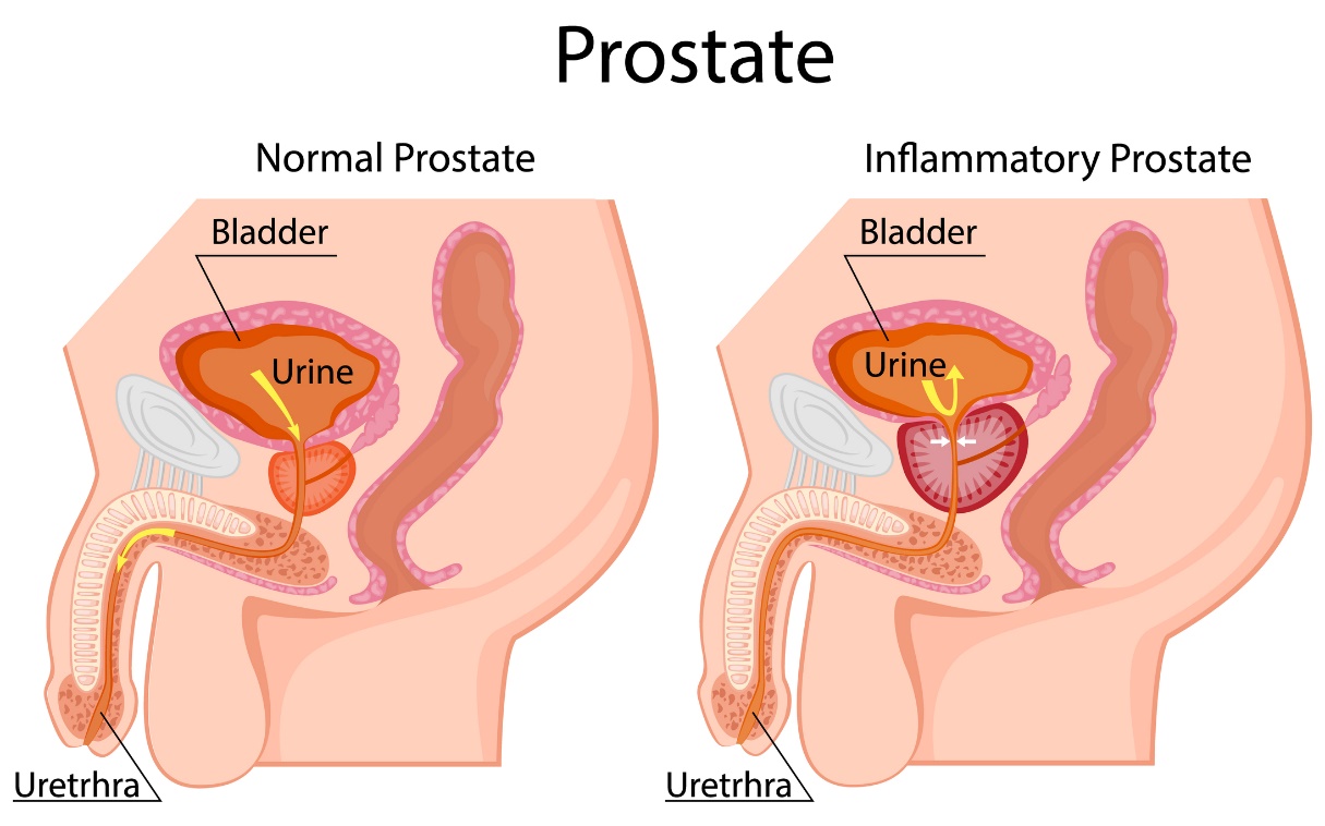 Levo: fiziološka prostata. Desno: povečana prostata. Nahaja se pod mehurjem. Mehur, urin, sečnica.