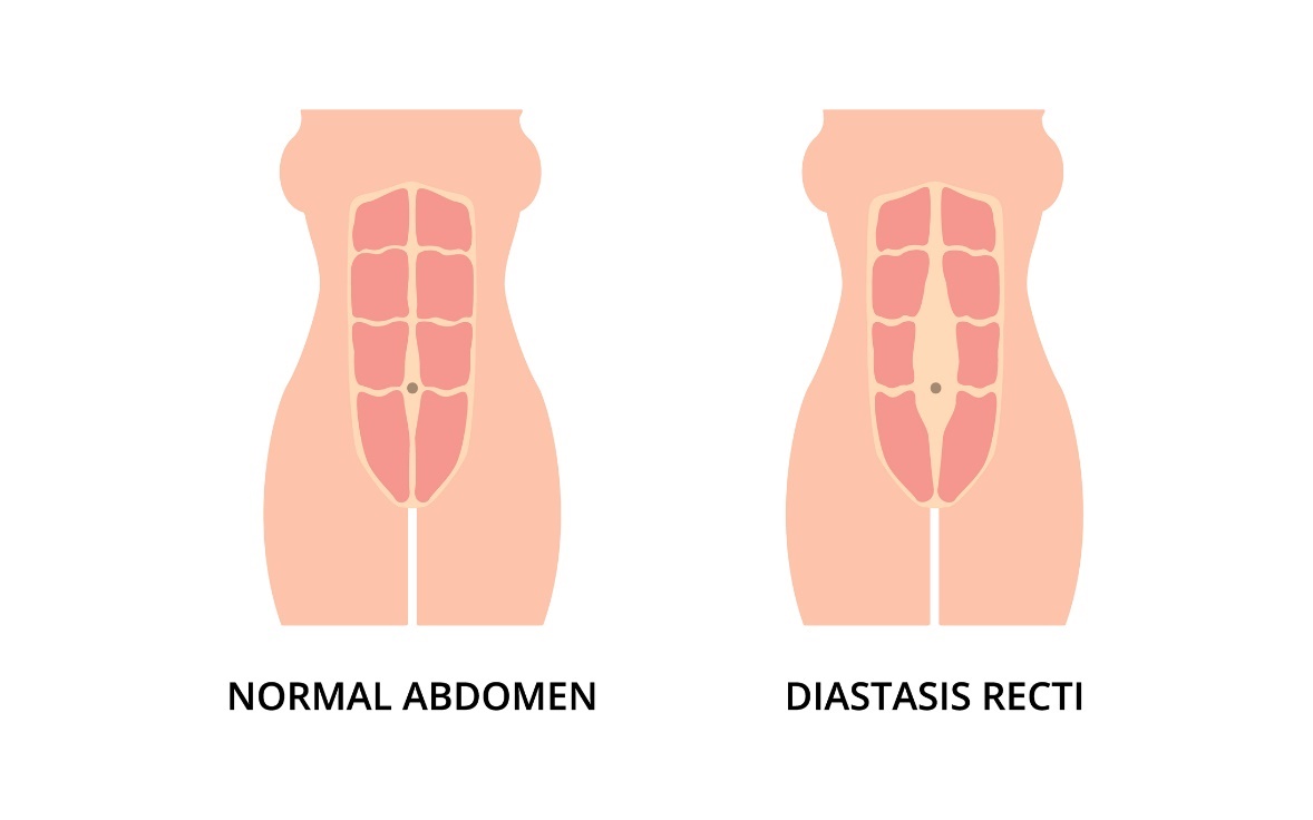 Fiziološko stanje trebušnih mišic in diastaza (razmik) leve in desne mišice rectus abdominis od sredine linea alba