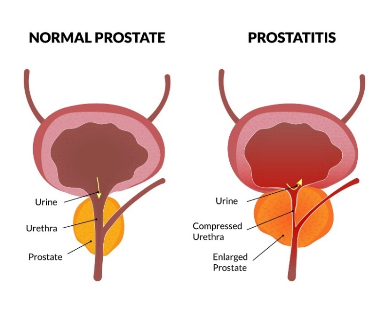 Fiziološko stanje prostate in prostatitis