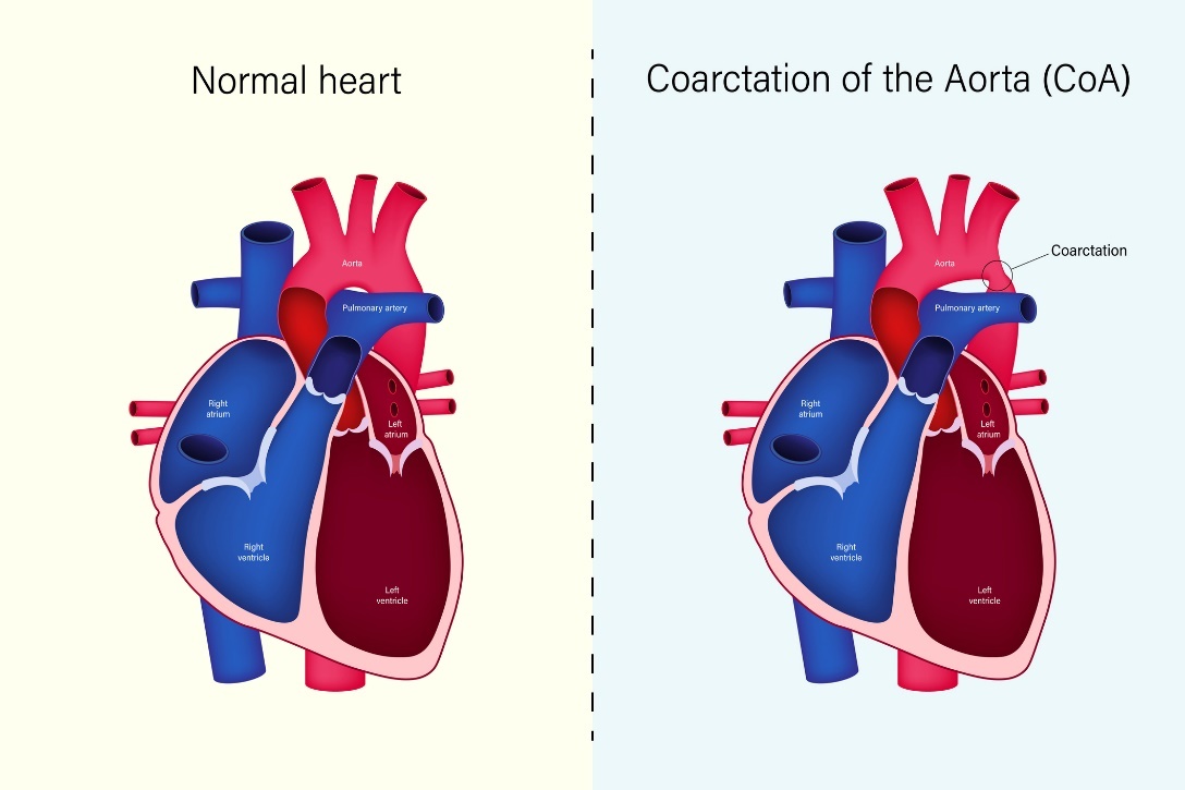 Fiziološko stanje srca in koarktacija aorte (CoA)