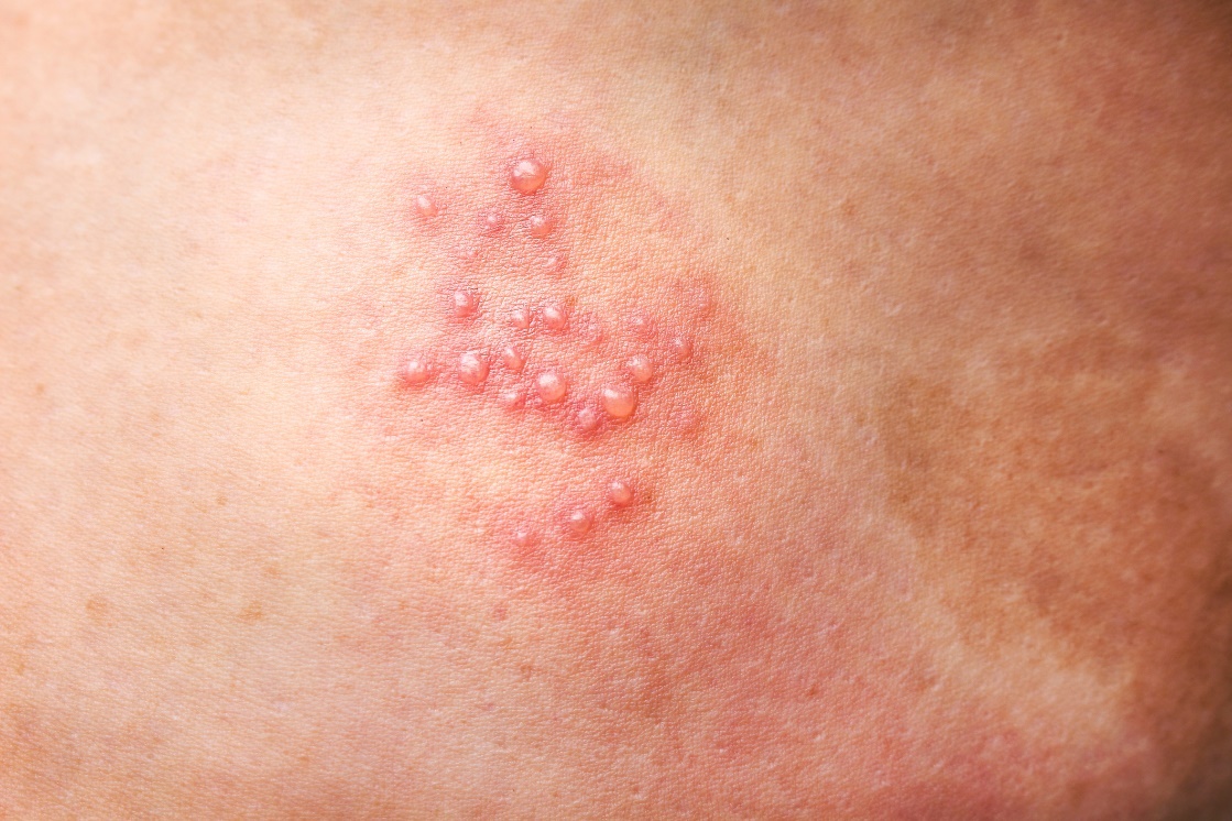 Genitalni herpes