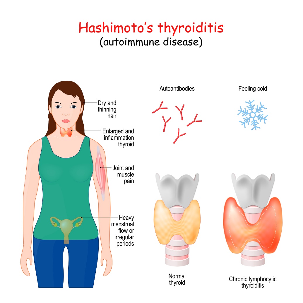 Hashimotov tiroiditis in klinični simptomi