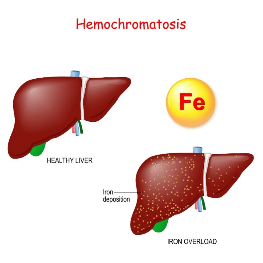 Hemokromatoza: fiziologija in patologija jeter s prekomernim odlaganjem železa (Fe)