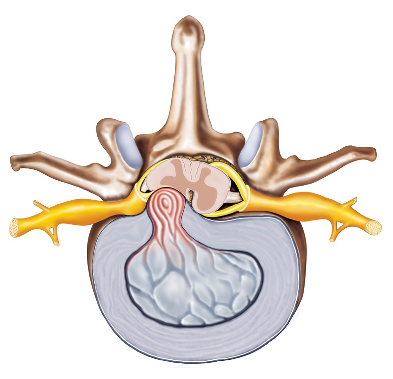 Hernija diska - anatomska predstavitev