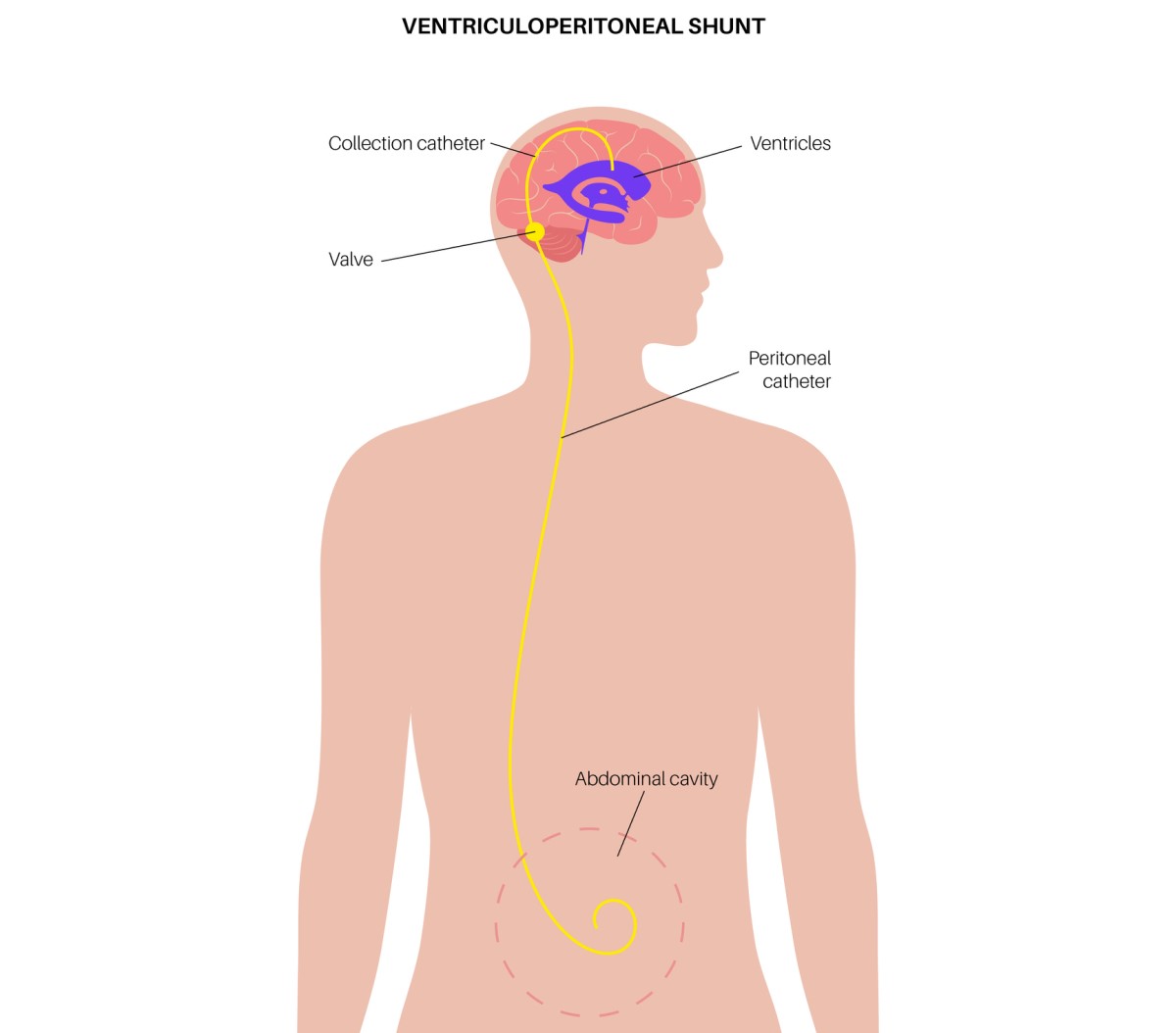 Ilustracija ventrikulo-abdominalnega šanta, ki odvaja odvečno tekočino iz možganov v trebušno votlino.