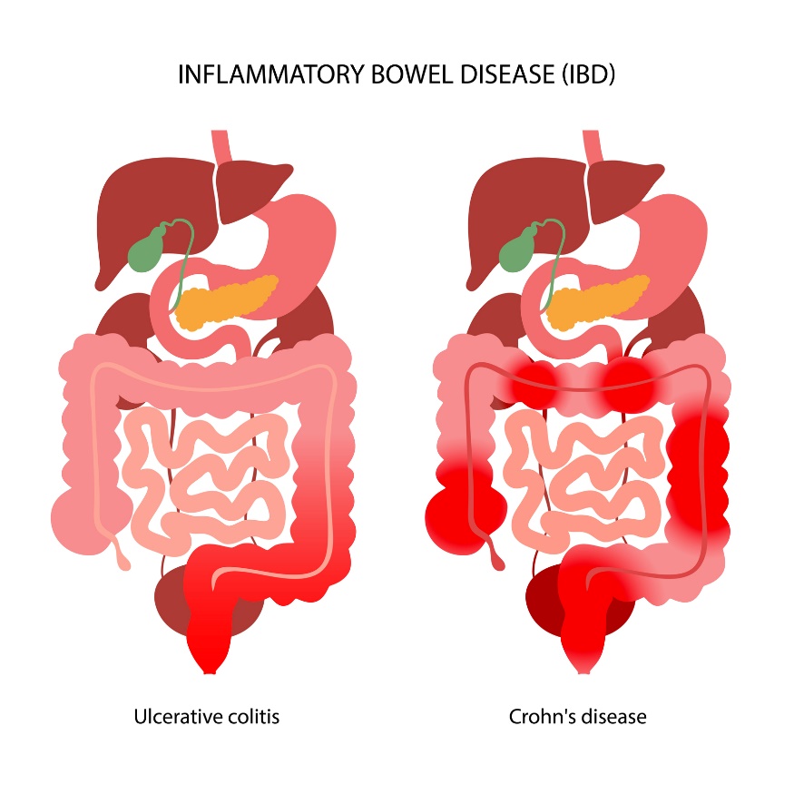 IBD: delitev na ulcerozni kolitis in Crohnovo bolezen glede na lokalizacijo vnetne reakcije.