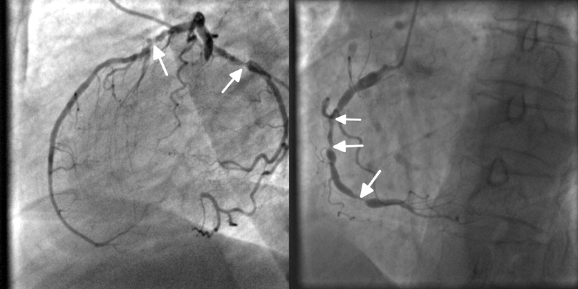 Koronarografija, angiografija, zamašitev koronarne arterije