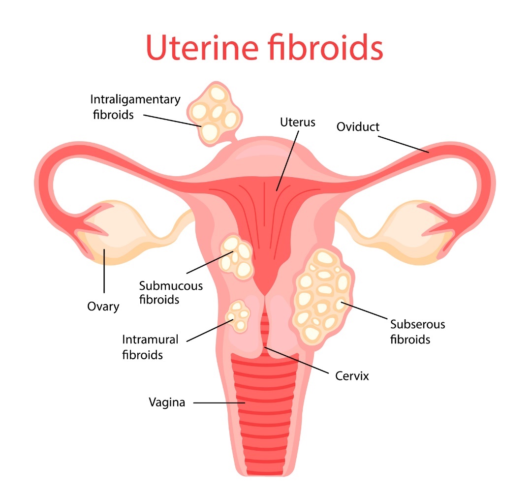 Maternični fibroidi (fibroidi maternice)