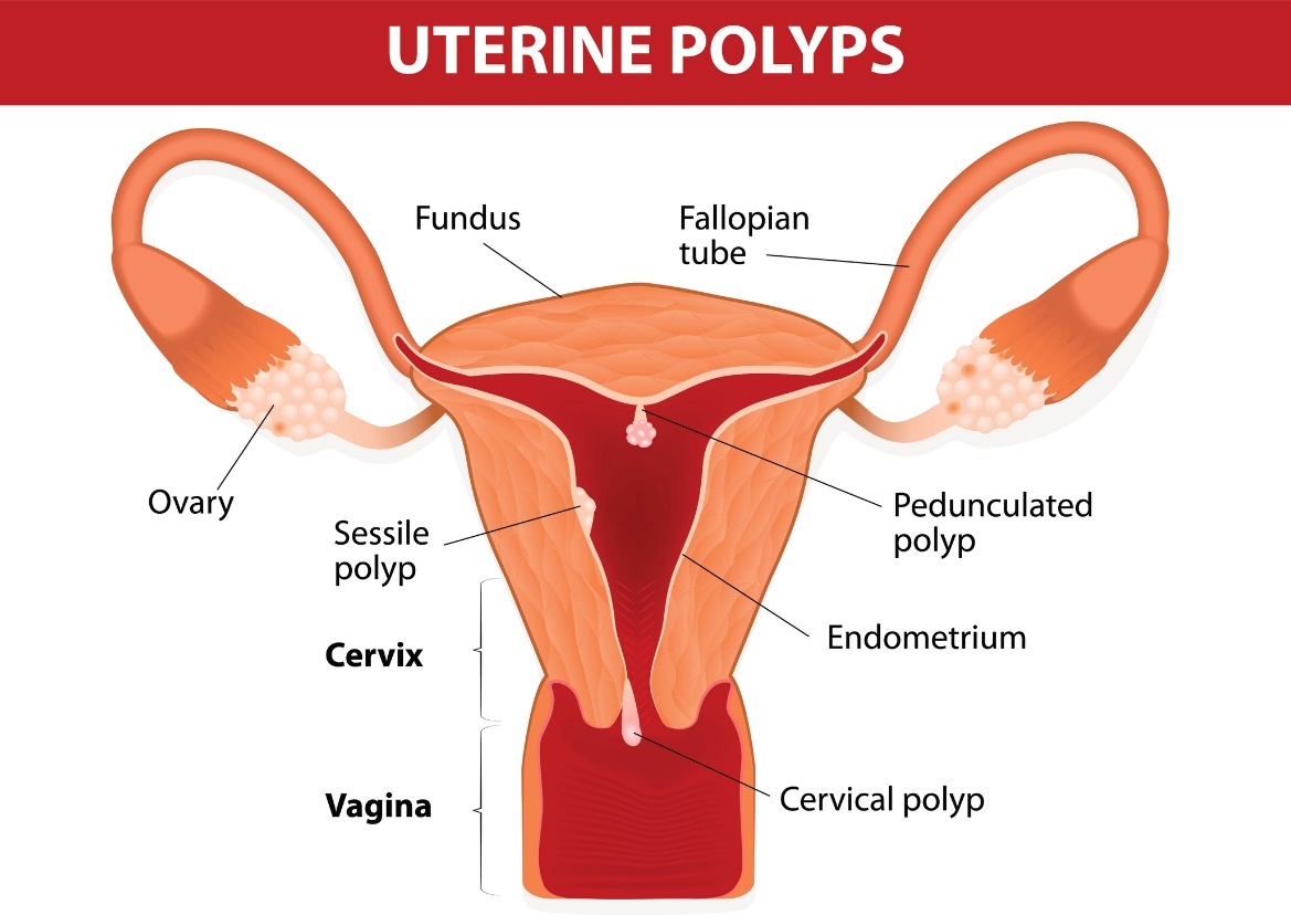 Polipi maternice