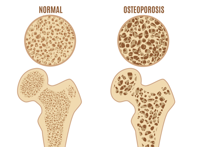 Osteoporoza stegnenice