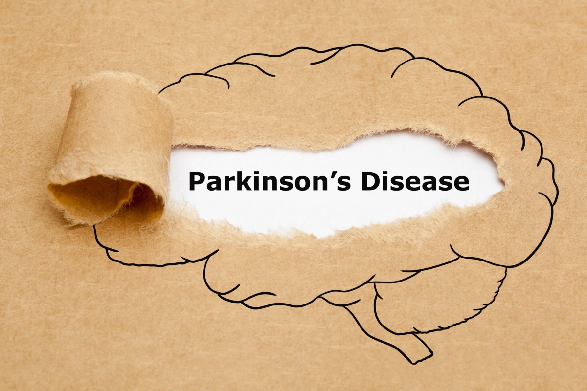 Morbus parkinson = Parkinsonova bolezen = Parkinsonova bolezen - animacija možganov s Parkinsonovo boleznijo v sredini