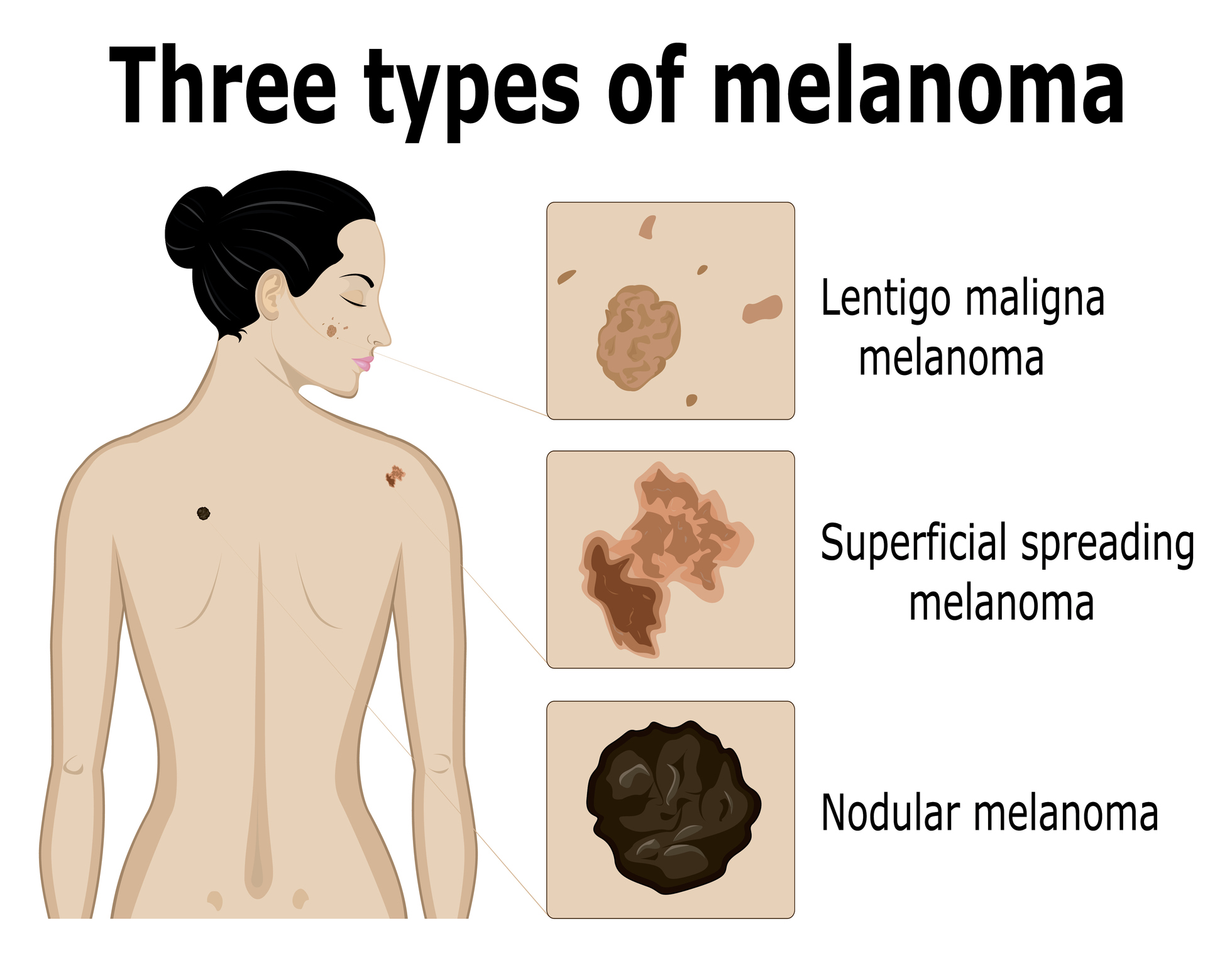 Slikanje treh vrst melanoma