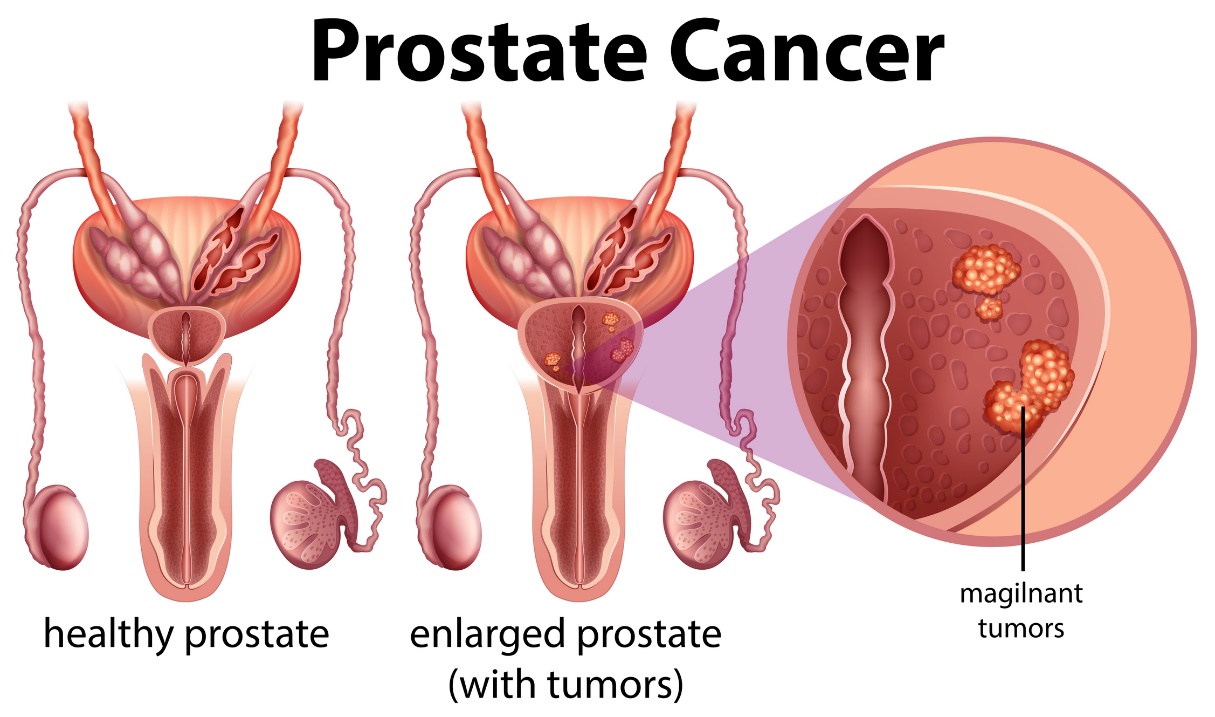 Rak prostate. Zdrava prostata in povečana prostata s tumorjem