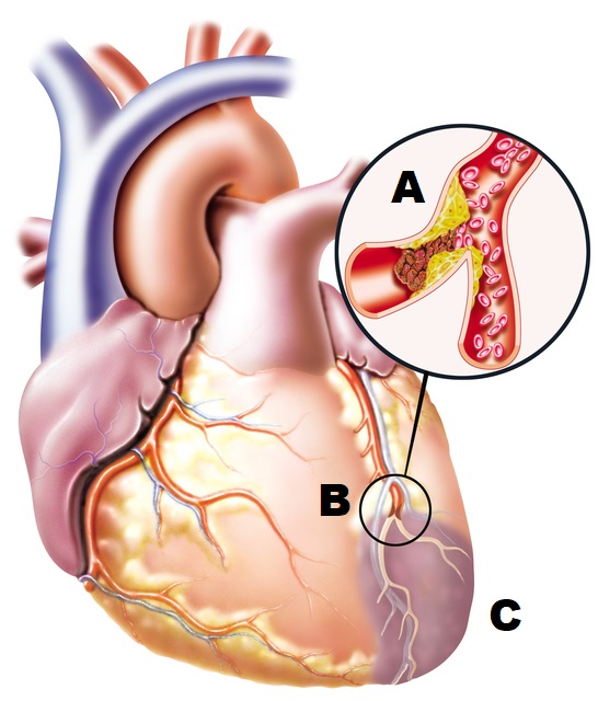 anatomska risba srca z zamašeno krvno žilo