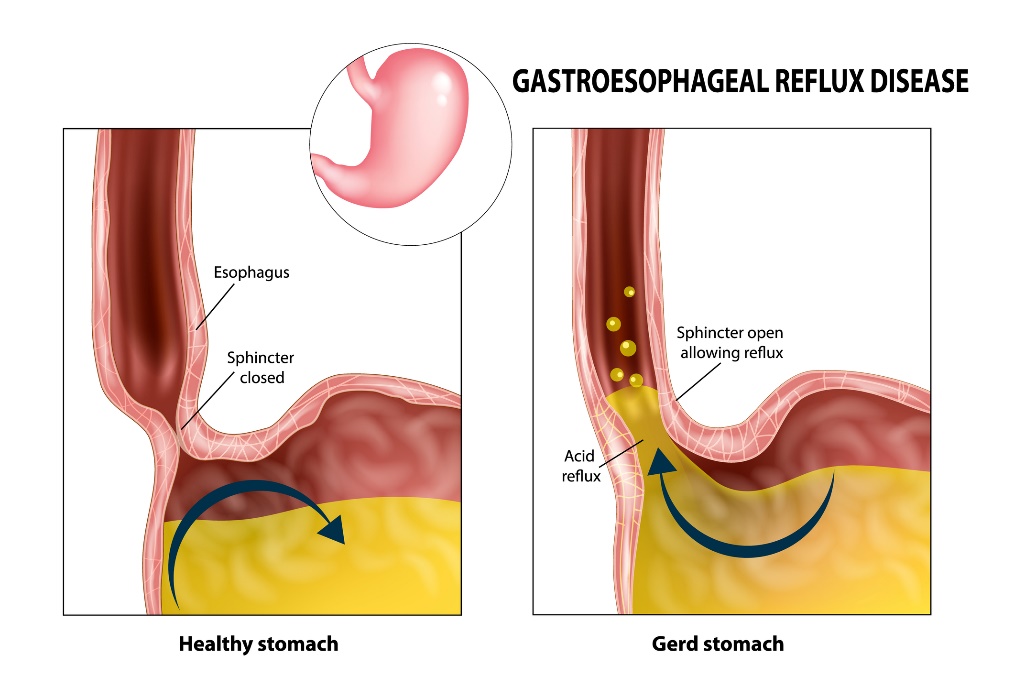 Gastroezofagealni refluks: požiralnik, sfinkter, želodec in želodčna kislina