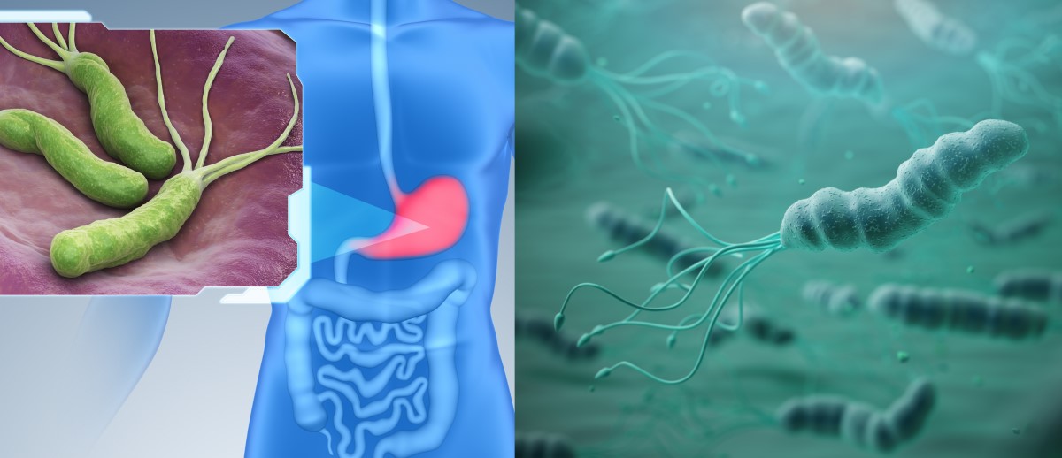 Helicobacter pylori naseljuje sluznico želodca in je dejavnik tveganja za gastritis, razjedo in raka.