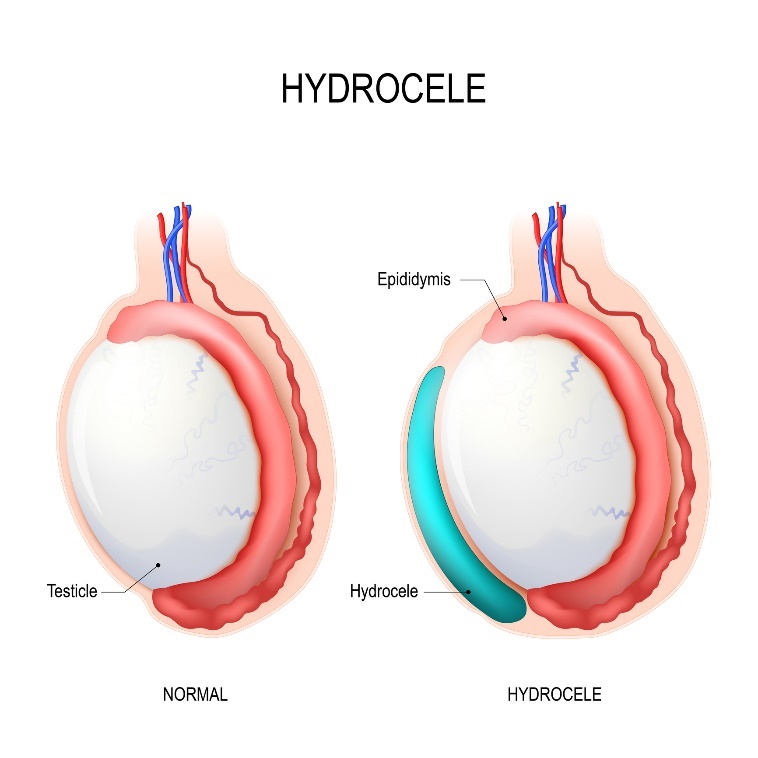 Hidrokela: Testis (moda), Epididimis (nadmodek), Hidrokela (nakopičena tekočina)