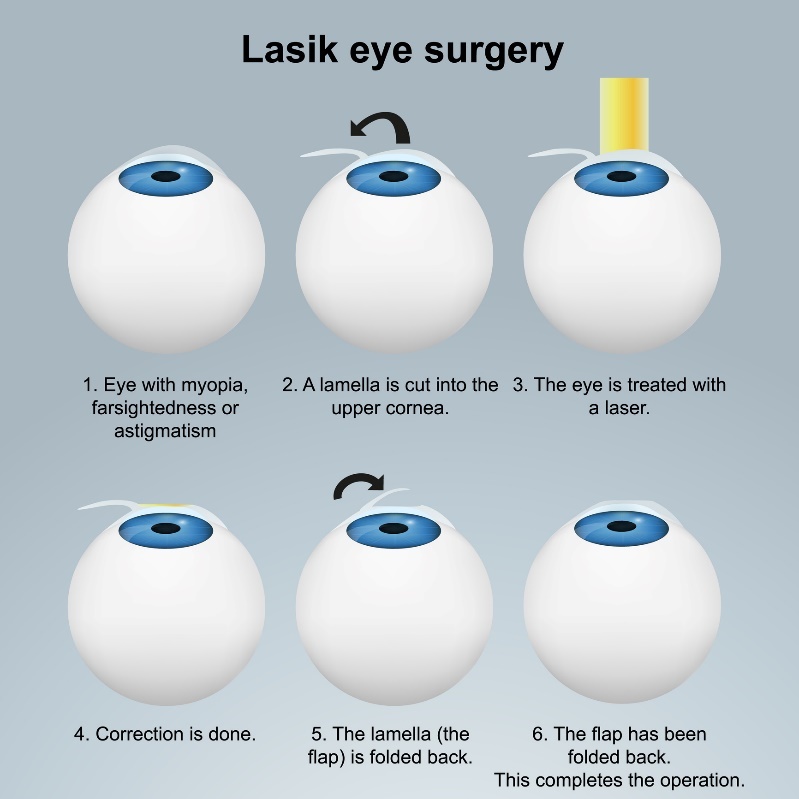 Laserska operacija oči LASIK - podpovršinska metoda. Postopek z zaklopko brez poškodbe živčnih končičev.