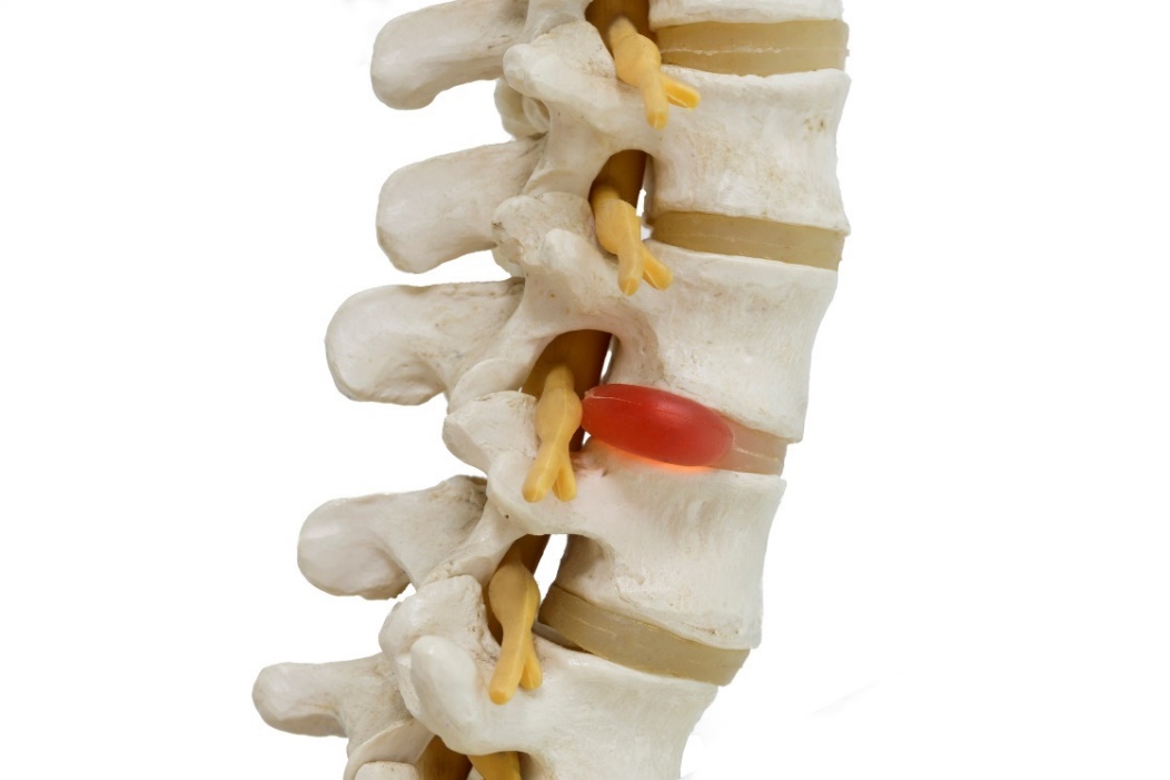 Anatomski prikaz 3D modela hrbtenice, medvretenčnih ploščic in hernirane ploščice s kompresijo živca