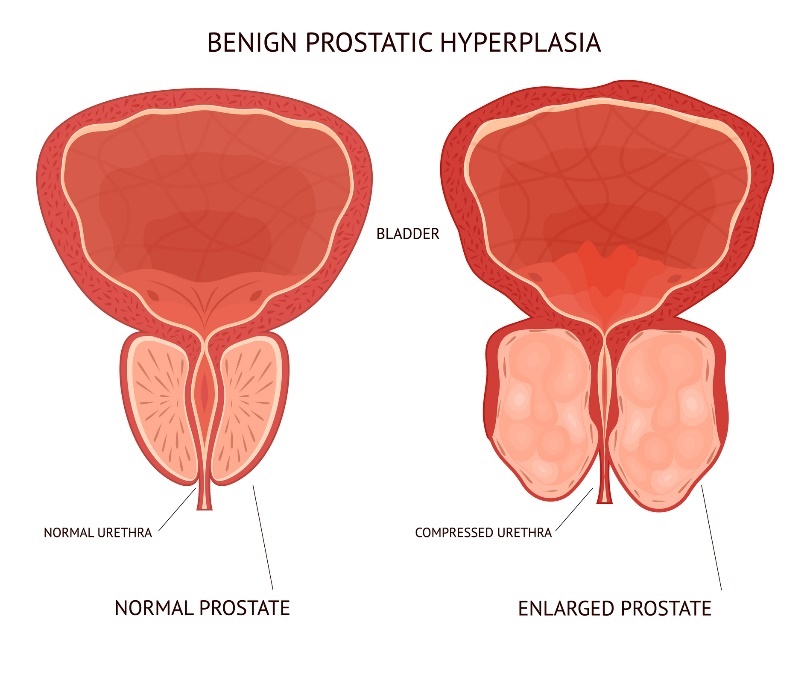 benigno povečanje prostate. mehur, fiziološko in povečano tkivo organa prostate.