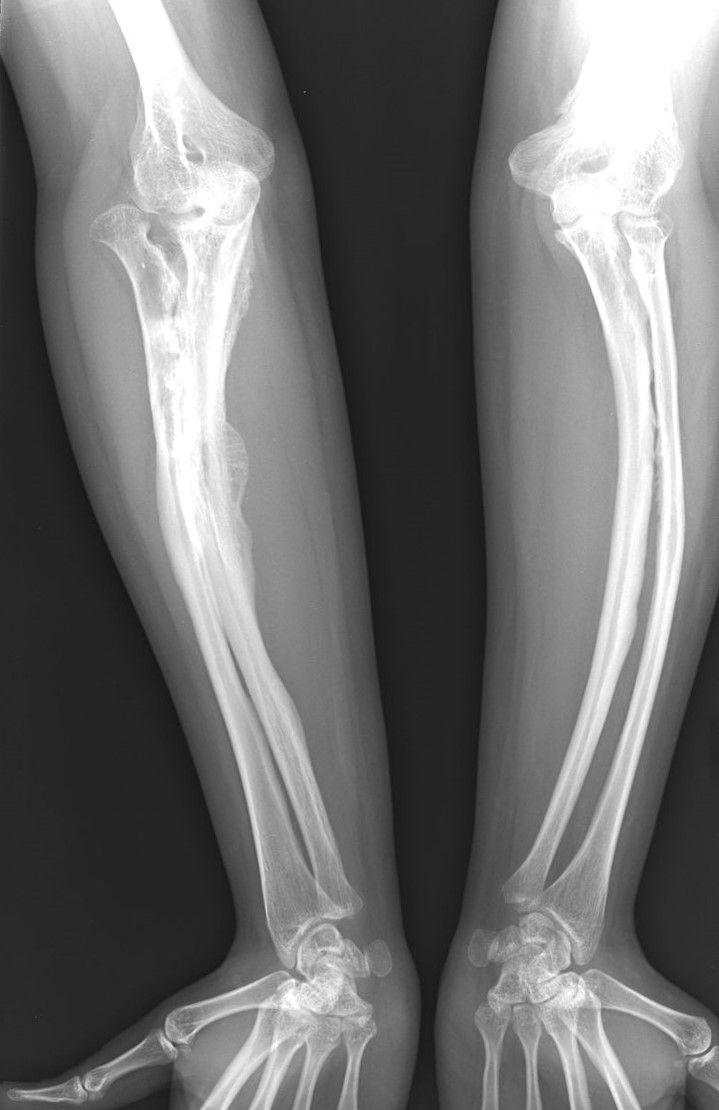 Rentgenske slike bolezni osteogenesis imperfecta pri odrasli osebi