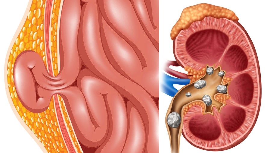 Hernija, ledvični in urinski kamni