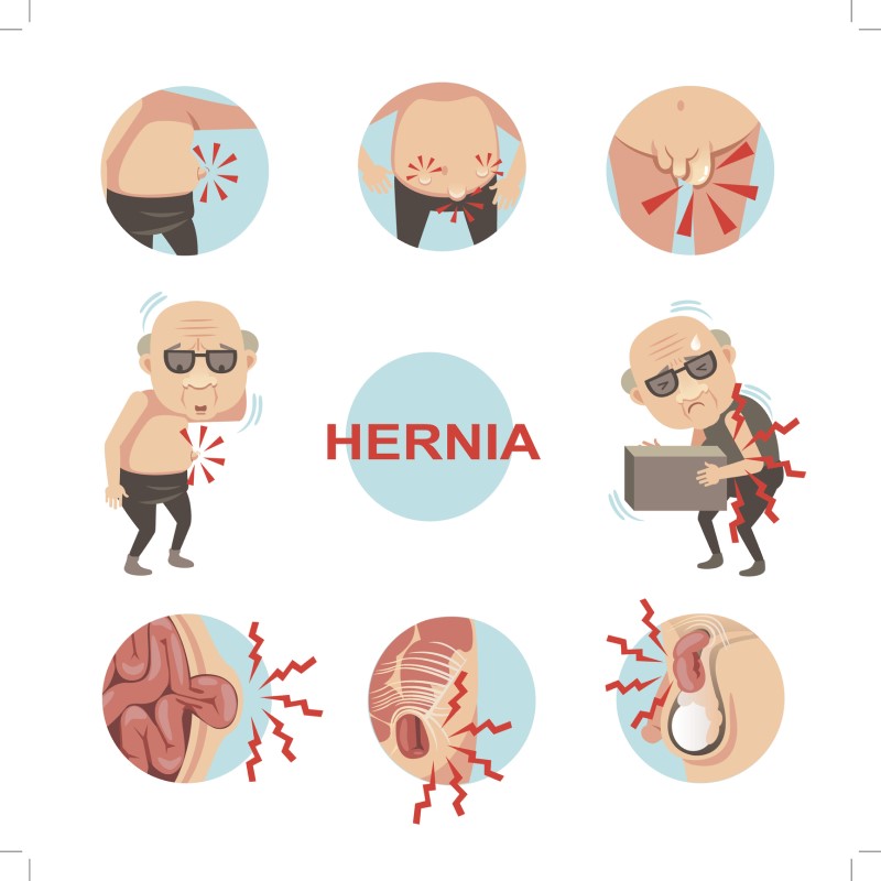 Infografika za hernijo