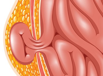 Hernija, najpogostejši zaplet ascitesa