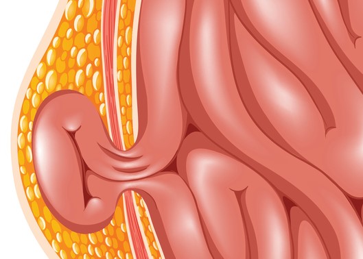 Model hernije, tj. hernije trebušne stene