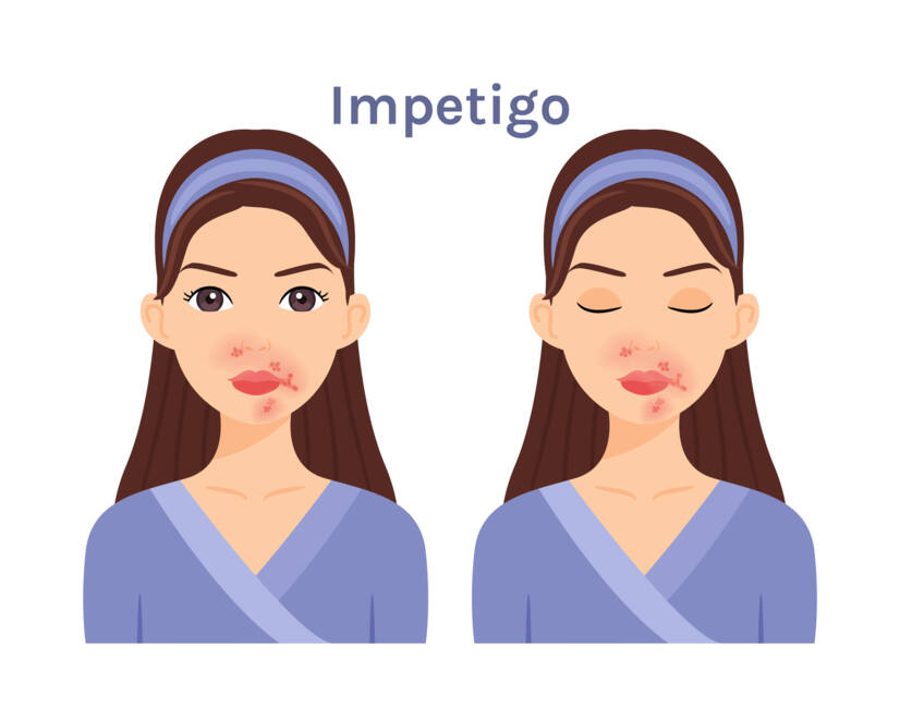 Kaj je impetigo in kakšni so njegovi simptomi? Nalezljivost in prenos pri otrocih