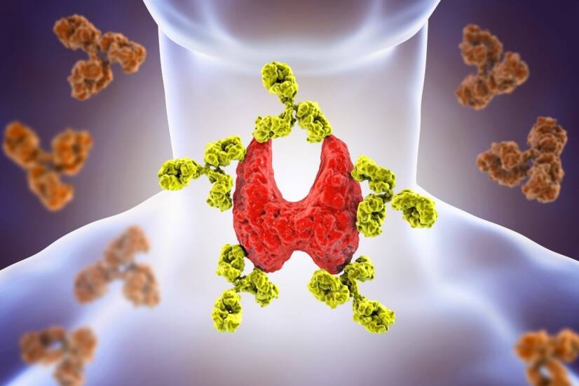 Avtoimunski tiroiditis: Hashimotova bolezen. Vzroki, simptomi