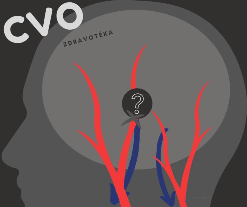 Cerebrovaskularna bolezen: oslabljene, zožene ali razširjene možganske žile? Poznajte vzroke in simptome