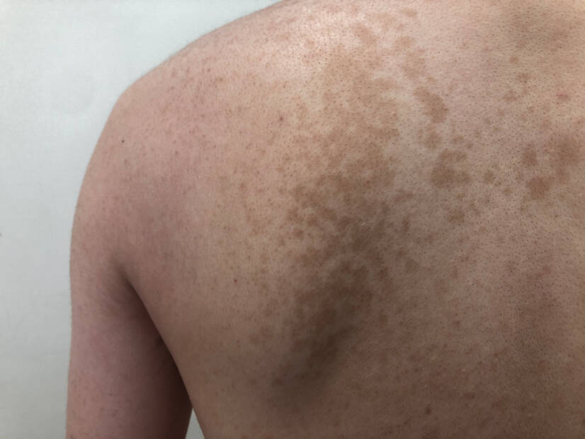 Pityriasis versicolor: kaj je to in kakšne simptome ima? Vzroki in prenos