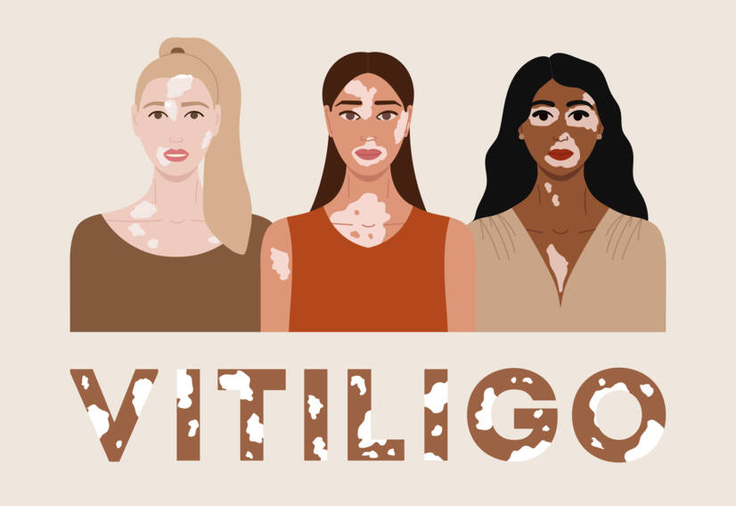 Vitiligo: Kaj je vitiligo ter kakšni so vzroki in simptomi? Kdaj se pojavi?