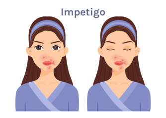 Kaj je impetigo in kakšni so njegovi simptomi? Nalezljivost in prenos pri otrocih