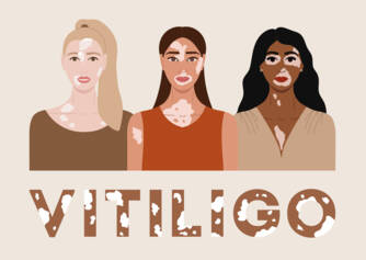 Vitiligo: Kaj je vitiligo ter kakšni so vzroki in simptomi? Kdaj se pojavi?